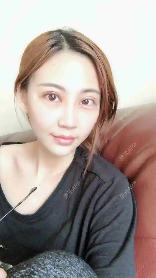 文爱克医生的全切双眼皮日记