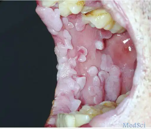 患者的性取向为男性,其男朋友存在生殖器疣病史.