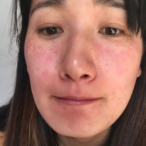 想请问一下孕妇脸上皮肤过敏能用药吗?