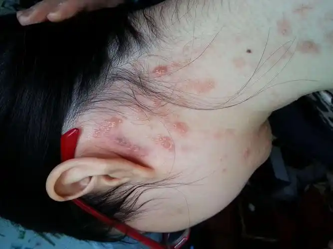 红斑狼疮图片_红斑狼疮症状表现图片大全_有来医生