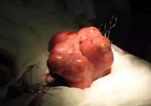 23岁孕妇4个月肚如"小山",得知真相,婆婆的话让医生一直夸赞