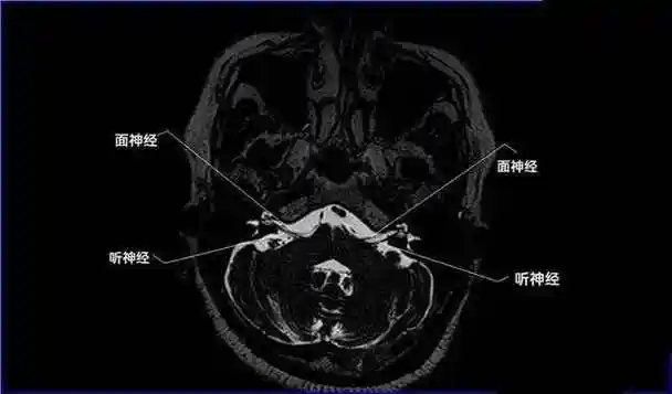 12对颅神经连续层面mri解剖