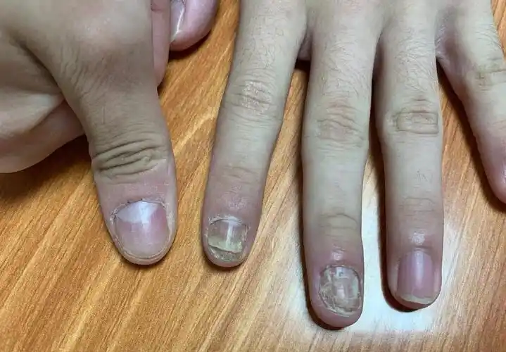 灰指甲是啥样的图片 灰指甲各个阶段图片