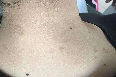 银屑病图片及症状图片吃什么药