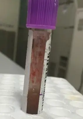 无法纠正的红细胞凝集结果到底该如何发