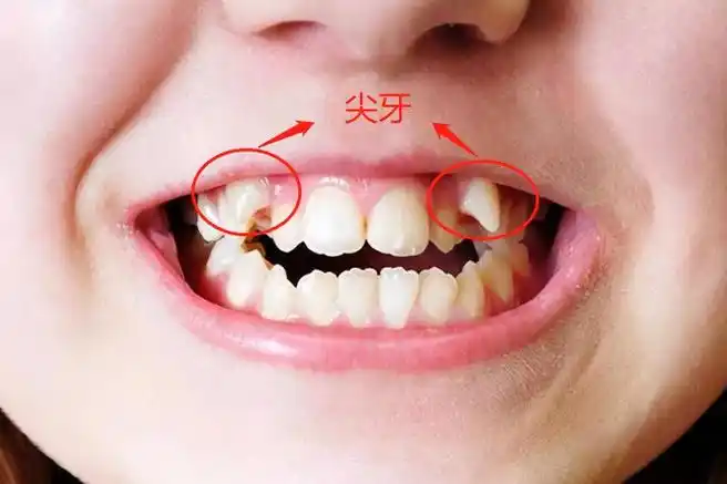 尖牙和虎牙的区别图片_图文_文章_美咯_让您放心美!