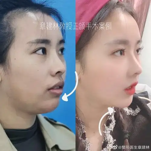 正颌手术前后下巴对比