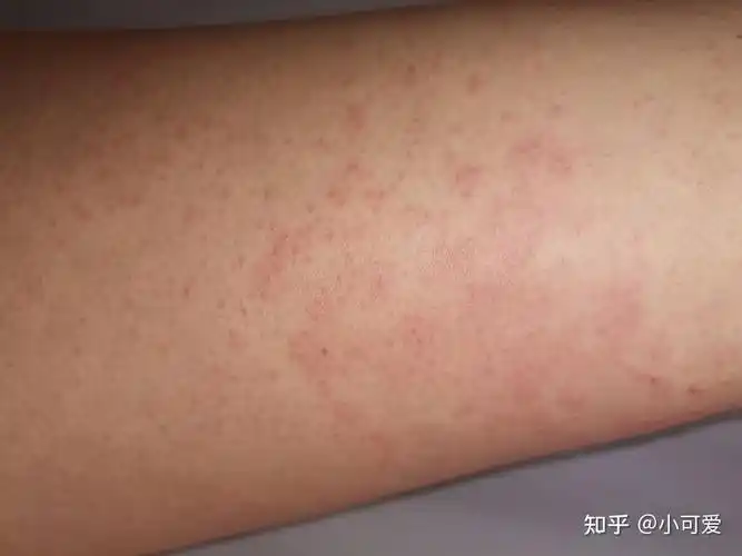 膏药过敏引发的过敏性皮炎治疗心酸历程(有图做好心里准备) - 知乎
