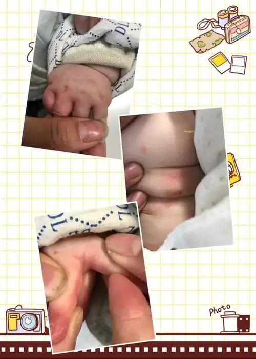 宝宝被传染了疥疮大都是父母的疏忽大意导致的