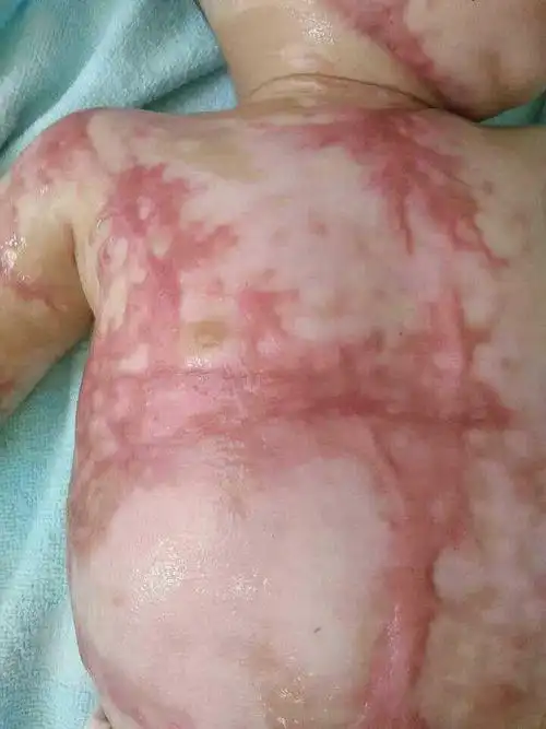 孩子烫伤,心疼死人了