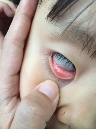 囡囡眼睛里长了一颗小白点,有谁知道这是什么?跪谢!