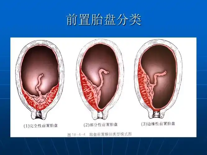 胎盘的发育及超声 课件ppt
