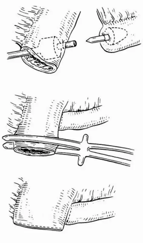 图12-1 回肠狭窄的切除与吻合(3)病变肠段狭窄成形术:适用于小肠及回
