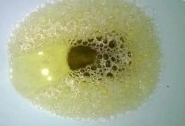 晨起上厕所时若出现3种症状,可能尿酸"结晶"了,需注意肾保养