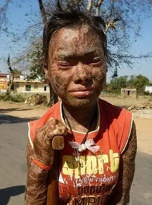 善举印少女患罕见皮肤病幸获帮助有望痊愈