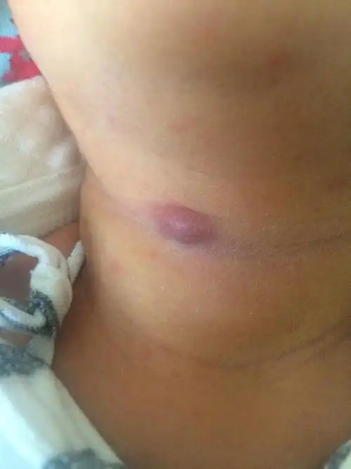 回答 你好,这是疖子,可以用75%的酒精消毒,在局部涂抹一些抗炎药物,擦