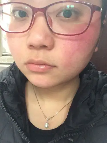 脸上红血丝明显,不少,经常红烫,有时候一大早起