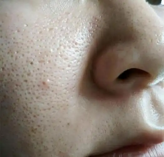 毛孔大,角质层厚像上面这种角质层过厚,气色油亮发黑,毛孔粗大,毛孔