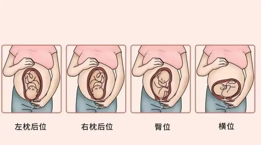 所以,为了母婴的健康,胎位不正的话,一般会选择剖腹产手术.