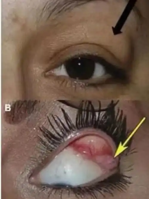 泪腺脱垂的症状一般会引起上眼睑下垂,肿胀,眼睛酸涩,眼睛有异物感