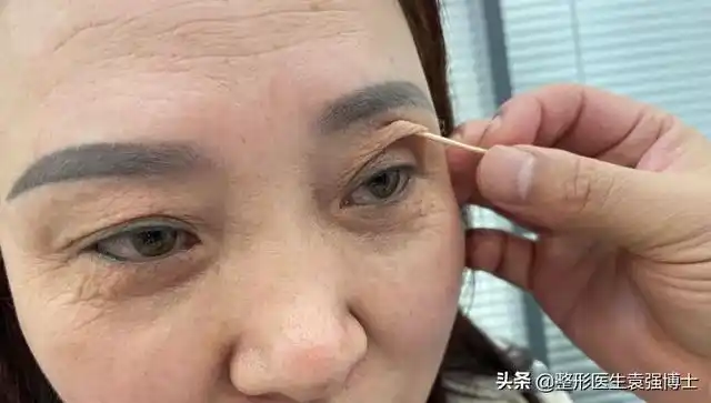 上眼皮严重下垂的解决办法(眼皮耷拉松弛三角眼)(4)