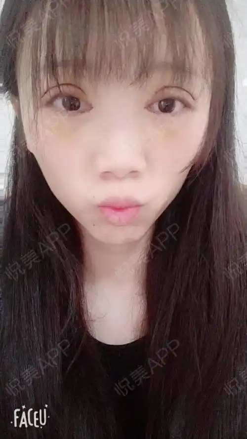 全切双眼皮术后6天_眼综合术后6天_开眼角术后6天_双眼皮术后6天_眼部