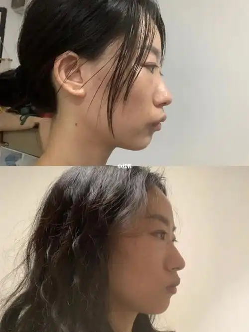 戴牙套一年又两个月还这样