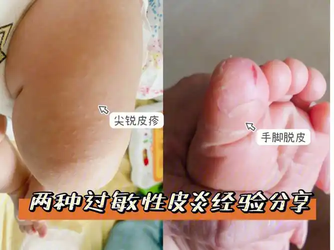 发现,治疗过敏性皮炎的经验分享