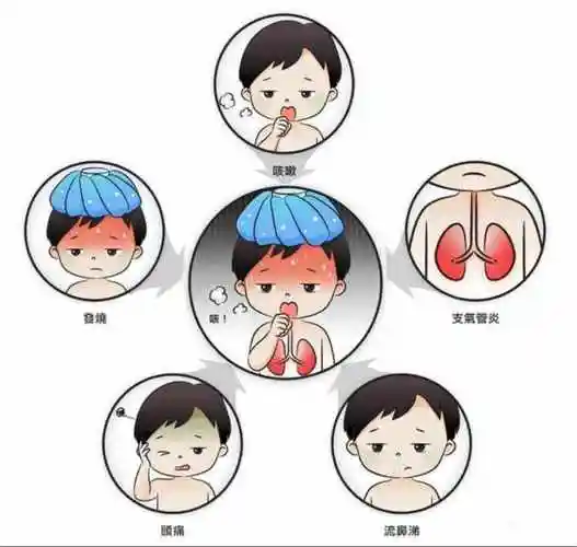 腺病毒感染可以表现为多种呼吸道症状,包括感冒和肺炎,甚至会影响眼睛