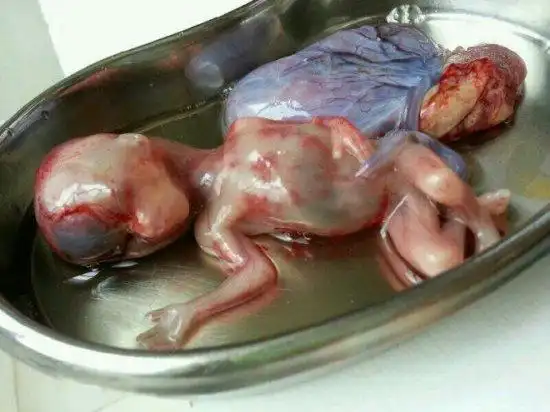 不忍直视 实拍血淋漓的堕胎场景