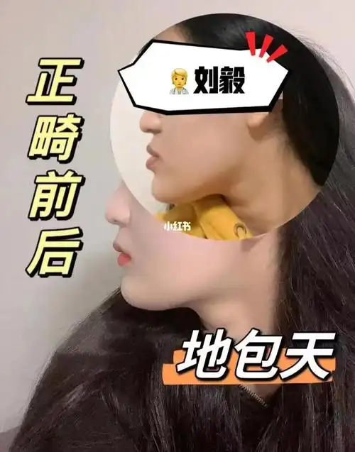 正畸前后对比,地包天拜拜!