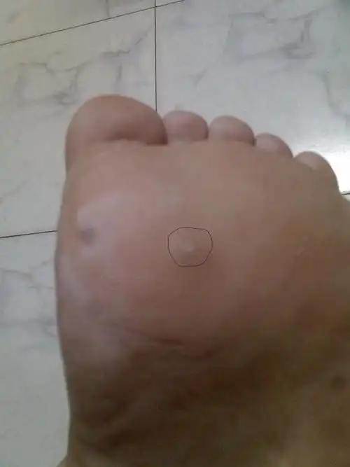 脚底前脚掌走路会痛 摸上去有突起_百度知道