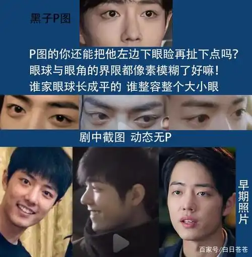 一边又说他做眼睑下至手术.