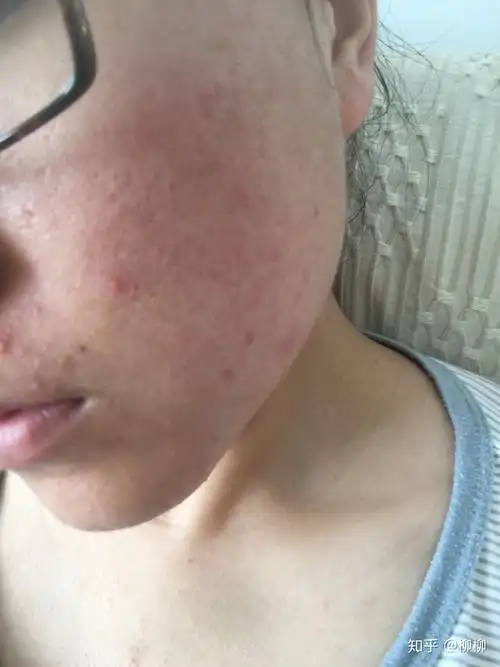 怎样去痘痘啊很自卑皮肤不好