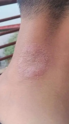 脖子后面不知道怎么了,被虫子咬过还是皮肤病?帮忙看看