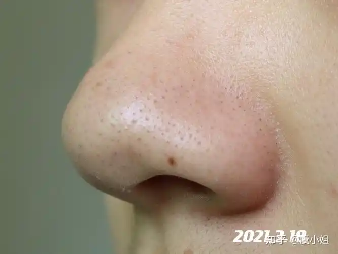 维a酸乳膏去黑头记录贴