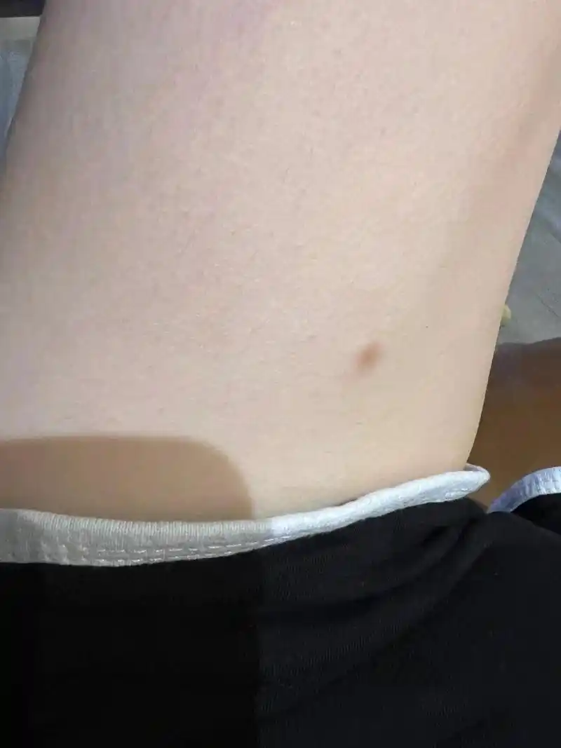 皮肤纤维瘤 大腿内侧长了一个纤维瘤,摸起来里面有点硬,长了两年多了