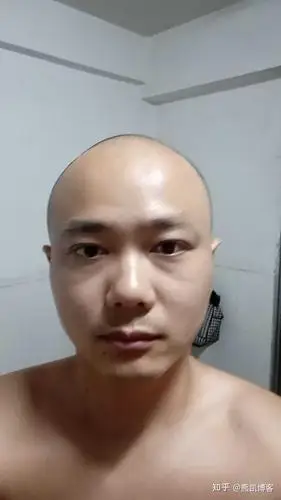 脱发,剃个光头需要多大勇气?