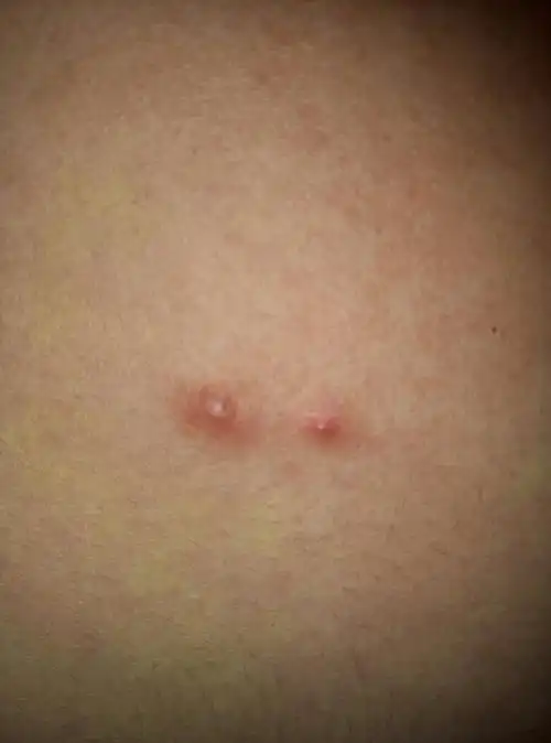 从年初开始,胸前有颗类似青春痘的东西,发炎挤掉脓后,毛孔增大,中间有