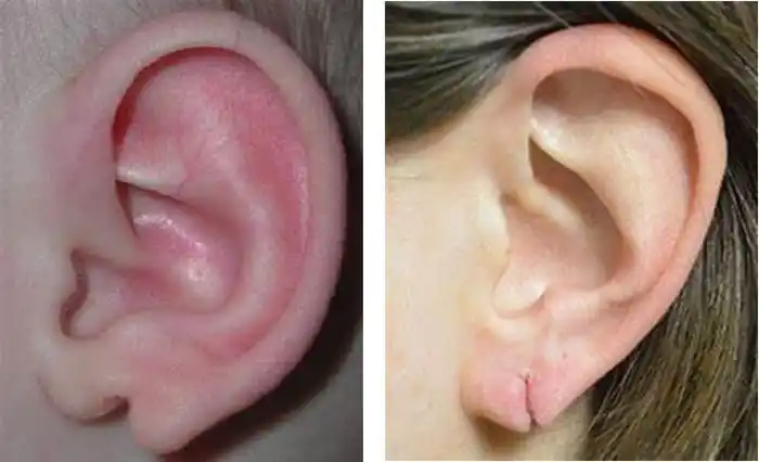 常见先天性耳廓畸形