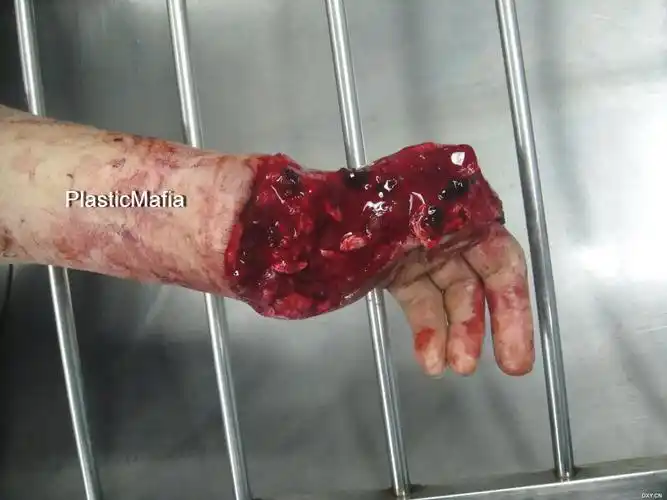 【讨论】肢体离断伤1例