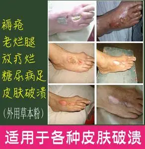 修肤新款全身外用粉用修复褥疮膏老烂腿放疗烂糖尿疾足烂皮肤破溃