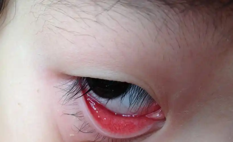 6岁小孩子 眼睛里边上下眼皮翻起 很红 特别是傍晚到晚上眼屎特别多