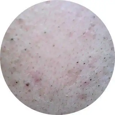 一篇带你了解白头粉刺和黑头粉刺,及可诱发痘痘的成分