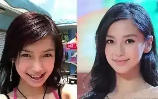 大家来看一下 angelababy牙齿矫正前后的照片(右边都为矫正后)