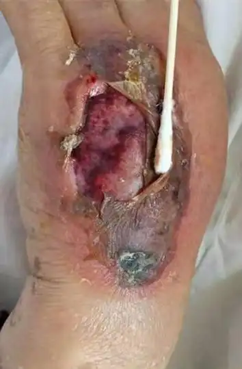 一例输液外渗致皮肤坏死的救治体会(满满干货,医护必读)