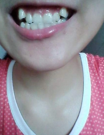 拔虎牙后的面容图片8