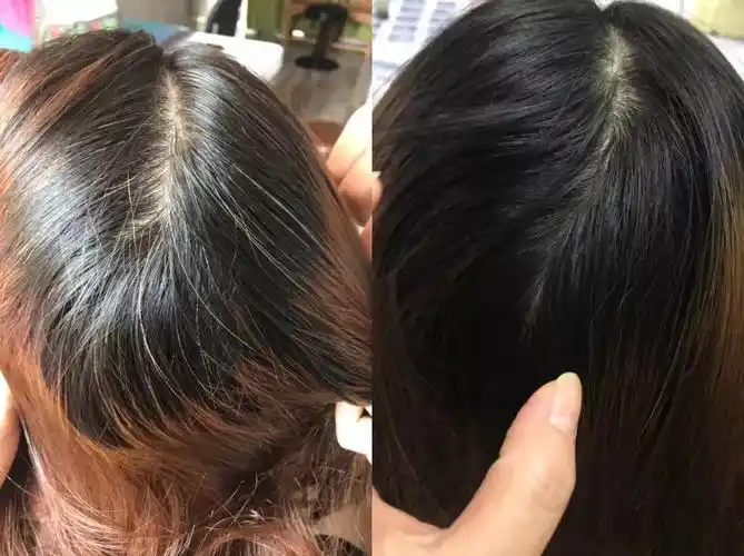 白发转发案例分享,拒绝假发~白发转黑发成功_手机搜狐网