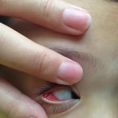 宝贝眼睑内长了两个包_宝宝树