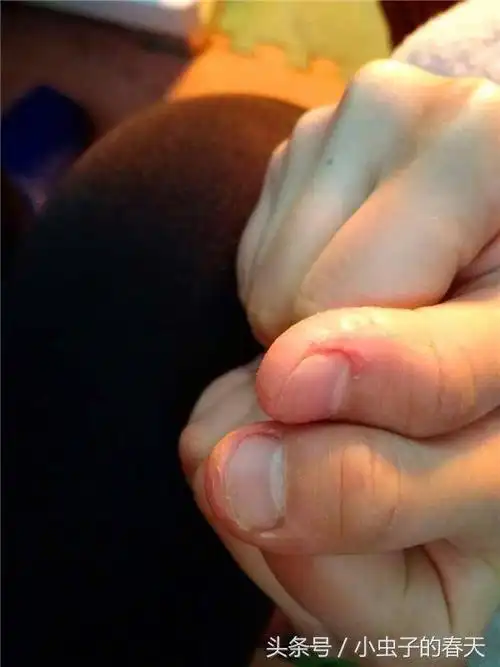 孩子咬过的手指甲,当妈的看着心疼